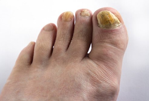 Picture of Fungal Nail Infection