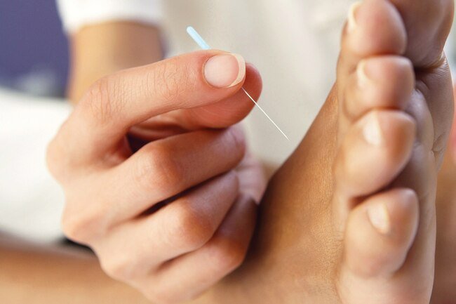 Acupuncture may help relieve DPN pain and encourage nerve healing.