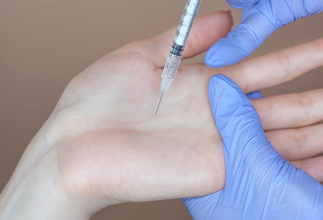 A digital nerve block is a procedure to anesthetize the fingers or toes (digits) by injecting an anesthetic solution at the base of the digit. The injection is widely used for local anesthesia, especially in the emergency department, where people often come in with digital injuries.