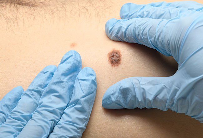 Skin cancer is the commonest type of cancer in the United States. The skin is the largest organ in the body with a surface area of around 2 sq ft in an average adult.