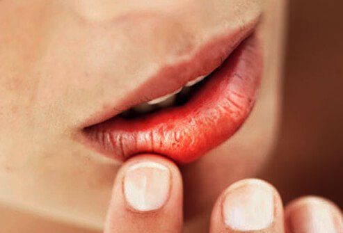 What Dry Mouth Feels Like