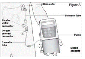 The CADD-Legacy 1400 pump - Illustration