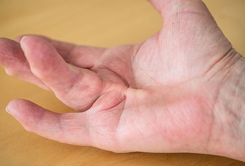 Dupuytren's contracture can prevent full extension of the affected finger.