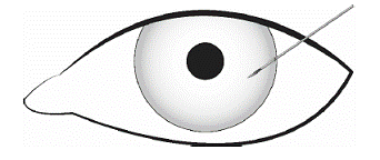 The needle should be inserted approximately 2 bevel
lengths with the bevel completely within the anterior chamber; avoid
positioning the needle bevel directly over the pupil Illustration