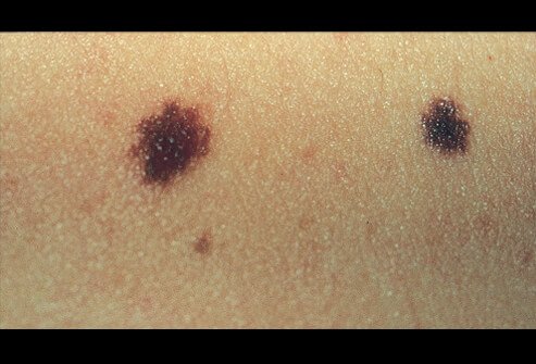 Picture of Dysplastic Nevus