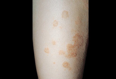 Nummular eczema (nummular dermatitis) is characterized by coin-shaped patches of irritated skin.