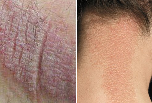 Lichen simplex chronicus, which is occasionally also known by the outdated term, localized neurodermatitis (a misnomer), appears as scaly patches of thickened, leathery skin.