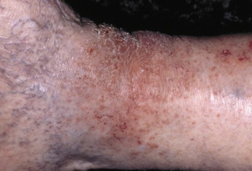 Stasis dermatitis is a skin irritation on the lower legs, generally related to the circulatory problem known as venous insufficiency.