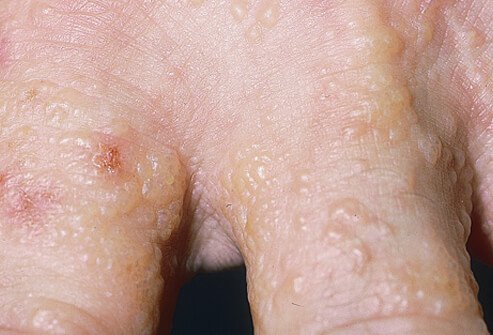 Dyshidrotic eczema (dyshidrotic dermatitis) is an irritation of the skin on the palms of the hands and soles of the feet characterized by clear, deep blisters that itch and burn.