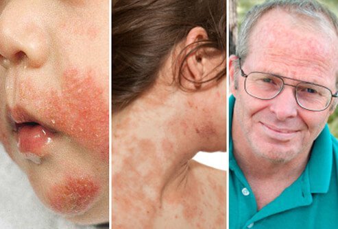 Eczema can affect people of any age, although the condition is most common in infants.