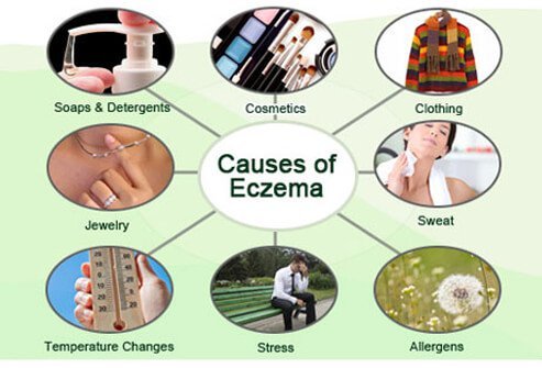 While not all of the factors that cause eczema are known, abnormal function of the immune system, gene defects, cutaneous irritants, and environmental allergens may lead to outbreaks in some people.