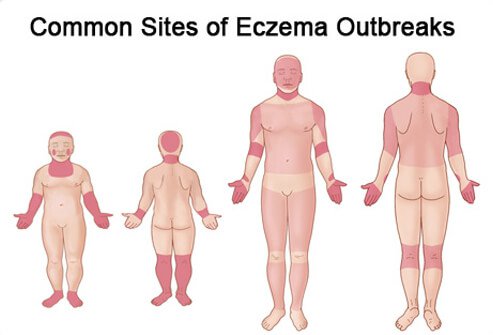 This illustration shows where eczema outbreaks can occur in children and adults.