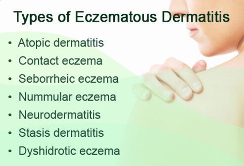 There are many types of eczema.