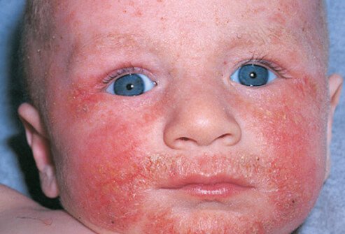 Atopic Dermatitis on a baby’s face.