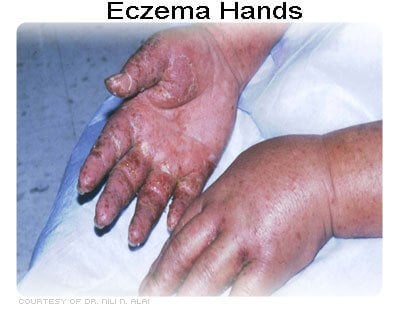 Photo of eczema on the hands