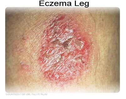 Picture of eczema on the leg