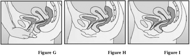gently push the EluRyng further up into vagina using index finger - Illustration