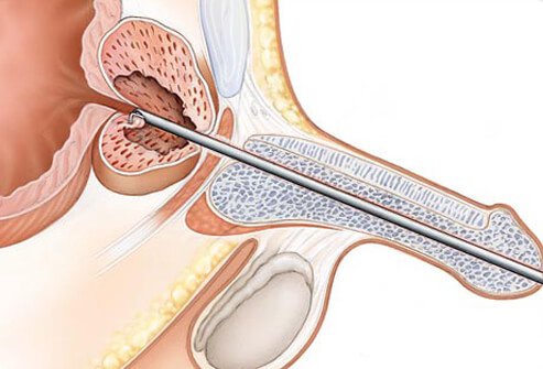 When medicines are not effective for symptom relief, procedures to remove excess prostate tissue can be considered. 
