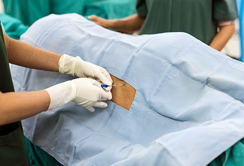 An epidural nerve block is a procedure to block pain by injecting anesthetic medication into the epidural space. The epidural space is the area between the inner wall of the backbone (vertebral column) and the outermost of the three membranes (dura mater) that surround the spinal cord. 