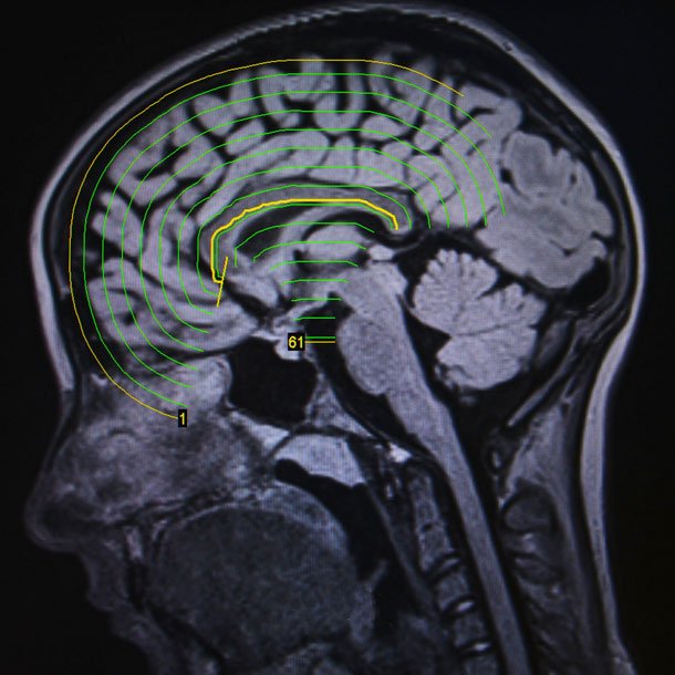 Epilepsy