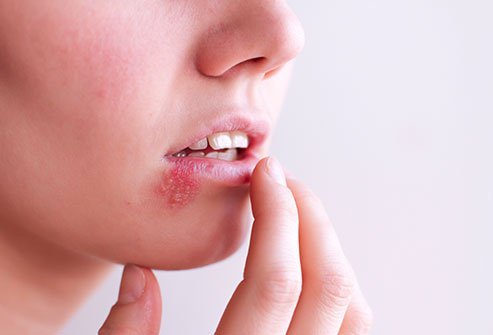 EBV can cause mouth sores.