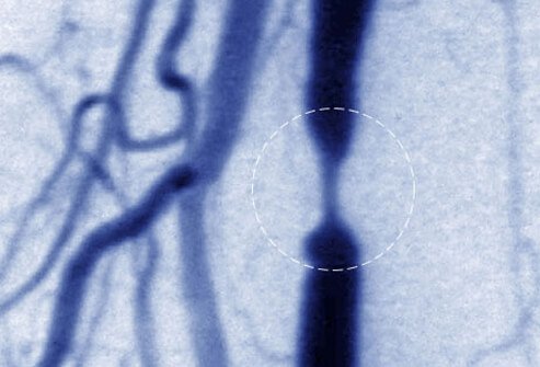 If erectile dysfunction is caused by a blockage in an artery leading to the penis, surgery can be used to restore blood flow. 