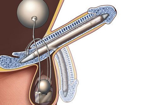 For those men with persistent erectile dysfunction, a penile implant can restore sexual function.