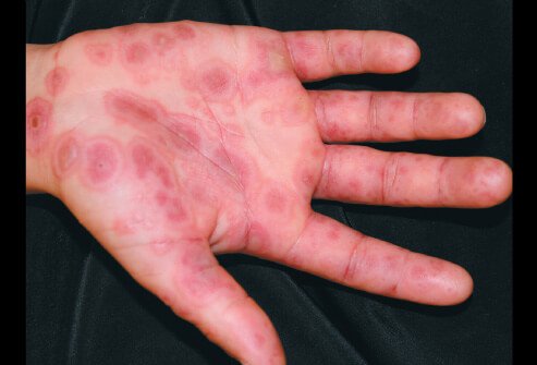 Picture of Erythema Multiforme