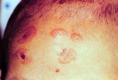 Hyperaemia refers to the movement of blood into a tissue while erythema is sometimes a symptom of hyperaemia.