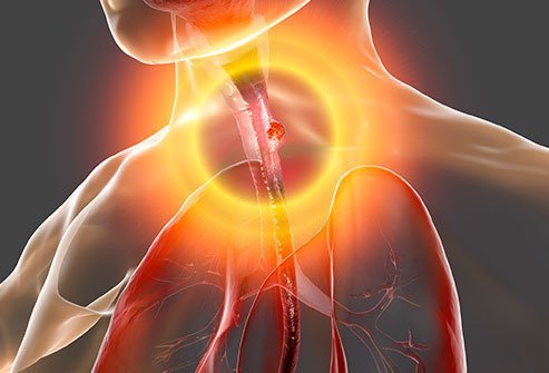 Gastroesophageal junction adenocarcinomas