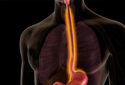Illustration esophagitis.