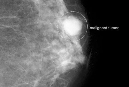 Learn when women should have a clinical breast exam. 