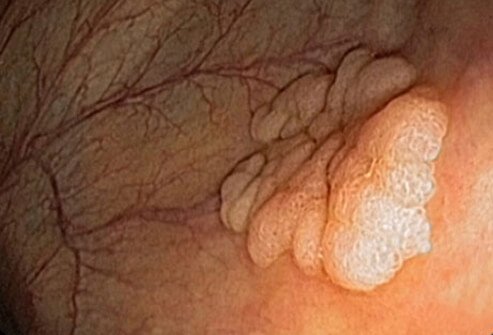 Malignancies may develop in the colon and rectum. 