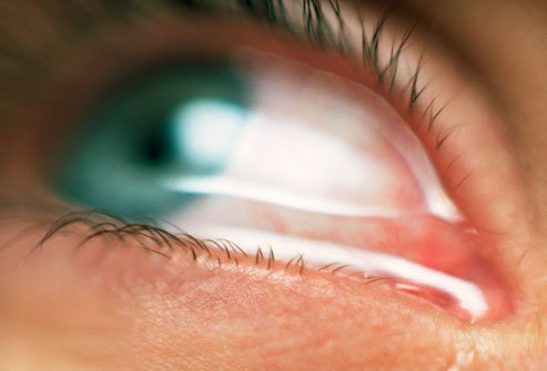 Allergic conjunctivitis symptoms vary from person to person.