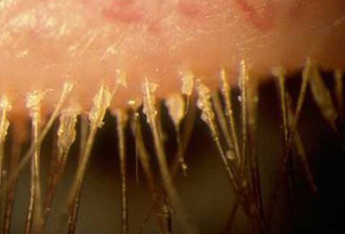 Picture of blepharitis
