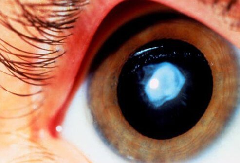 Photo of eye with cataract.