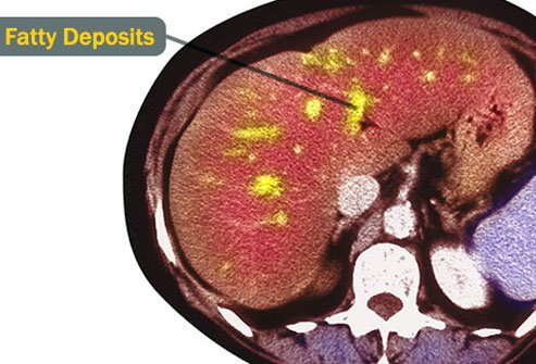 Accumulation of fat in the liver may lead to fatty liver disease and may compromise liver function. 