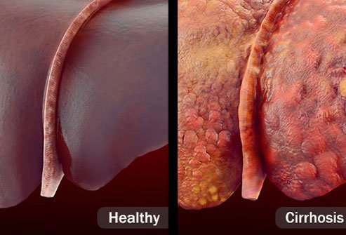 Fatty liver disease nonalcoholic is the more common form and may lead to cirrhosis. 