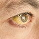 Jaundice (Hyperbilirubinemia) in Adults
