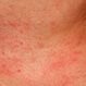 Anaphylaxis