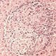 Brucellosis