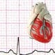 Cardiomyopathy (Hypertrophic)