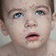 Is Chickenpox Contagious?