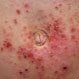 Contact Dermatitis