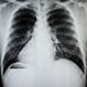 COPD (Chronic Obstructive Pulmonary Disease)