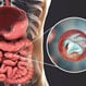 Cryptosporidiosis