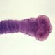 Cysticercosis (Pork Tapeworm Infection)