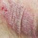 Eczema