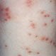 Folliculitis