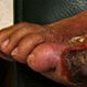 Gangrene